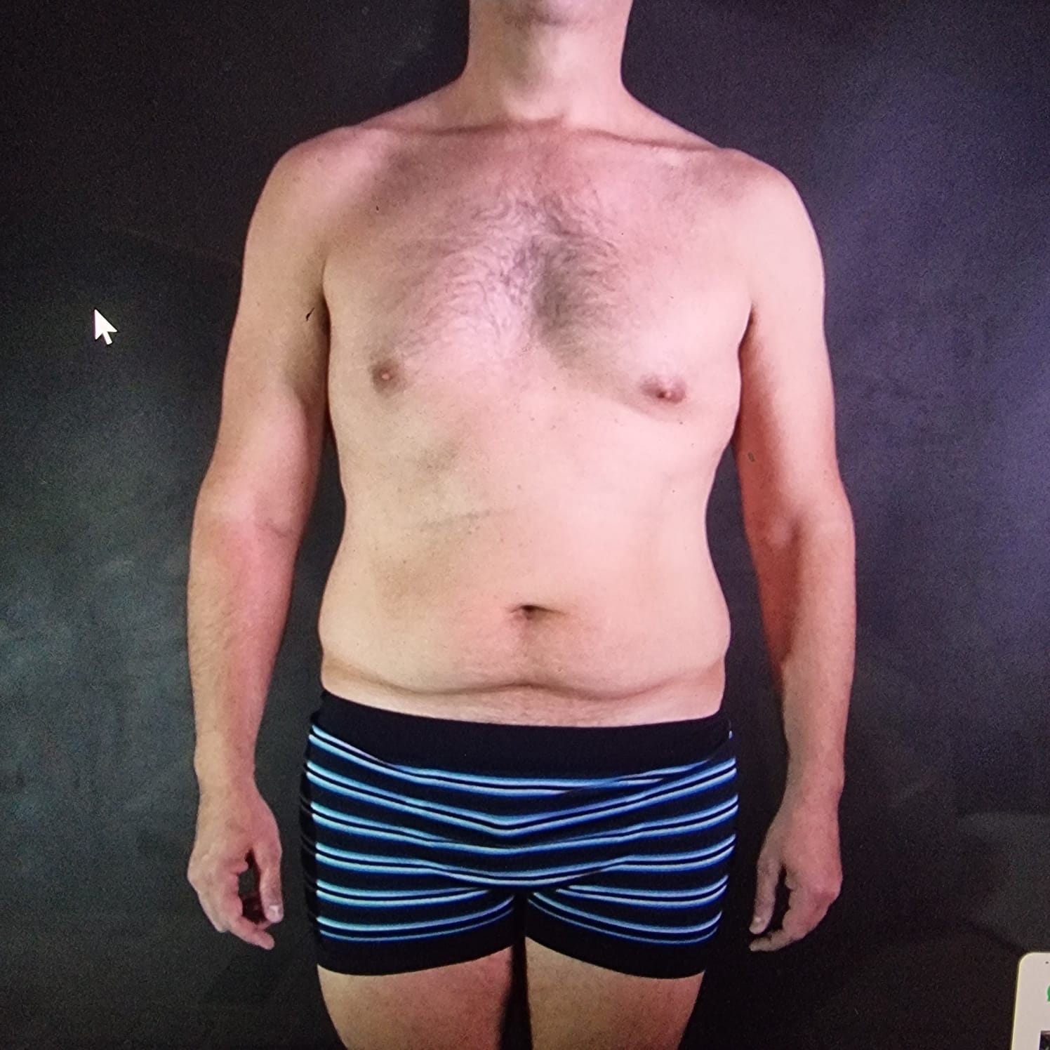 Antes — contorno abdominal